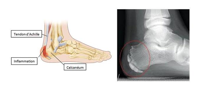 Schéma interne du pied