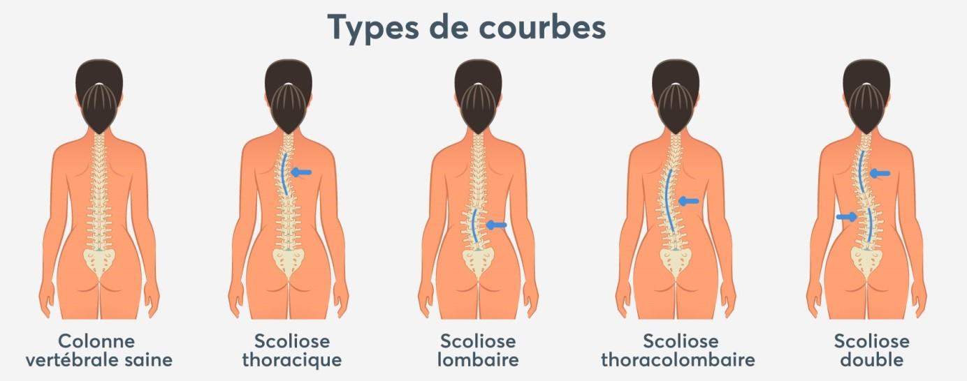 Shéma des  types de scoliose
